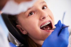 Leia mais sobre o artigo Aparelho dentário: Quais os cuidados necessários?